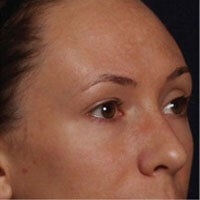 Chemical Peel Results