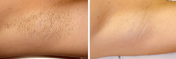 Laser Hair Removal Elgin and Algonquin IL