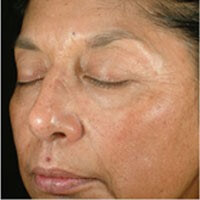 Chemical Peel Results