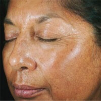 Chemical Peel Results