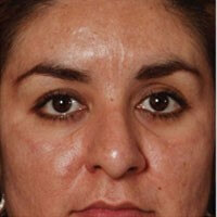 Chemical Peel Results