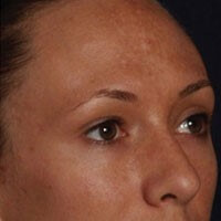 Chemical Peel Results